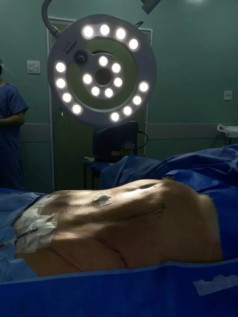 Lipoabdominoplastia Minimamente Invasiva (M.I.L.A) no Rio de Janeiro