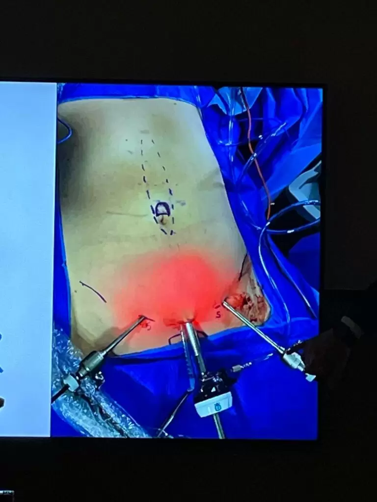 Lipoabdominoplastia Minimamente Invasiva (M.I.L.A) no Rio de Janeiro