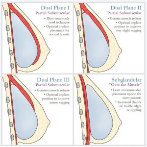 protese de mama, implantes, formato, volume e textura